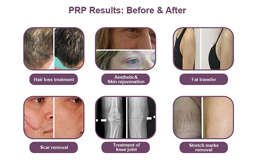 9ml Activator PRP Tube WithActivato