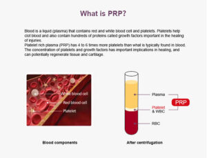 15ml PRP Tube With Anticoagulant And Separation Gel