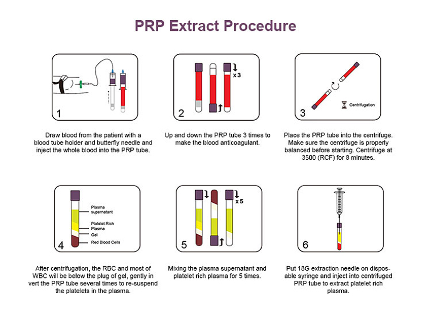 PRP Tube With Anticoagulant And Separation Gel