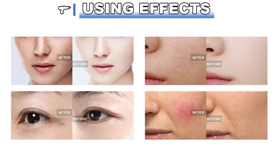 PRP Mesotherapy Meso Gun