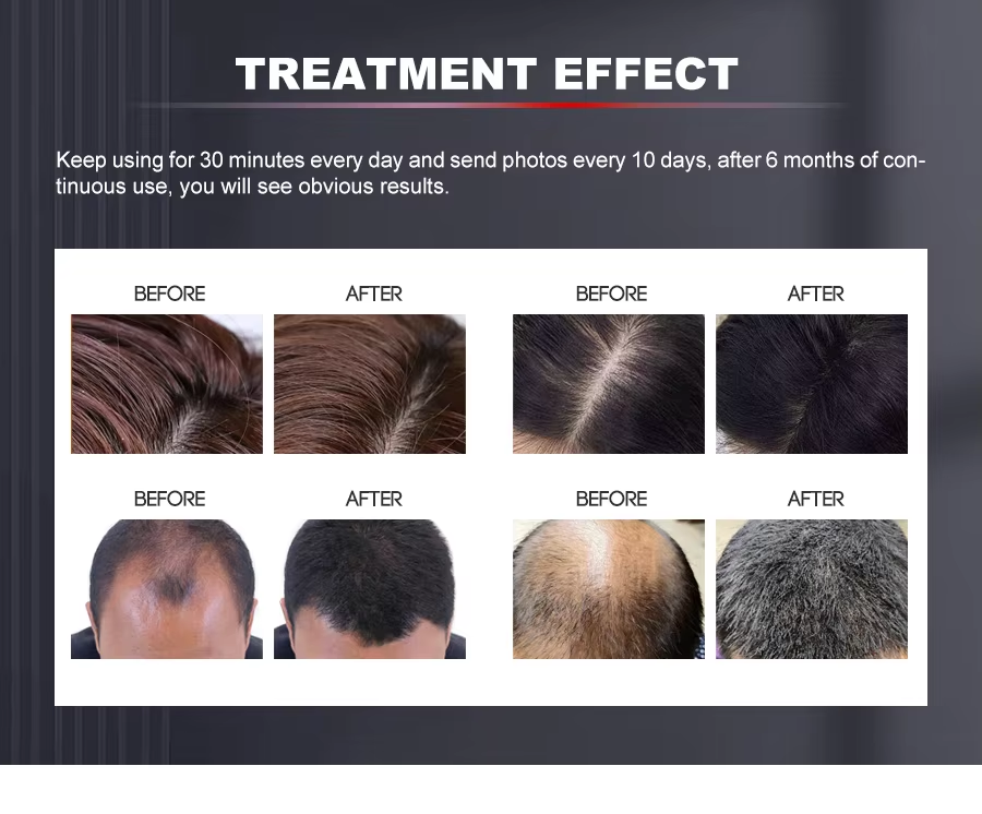 Hair Helmet Hair Growth Laser Therapy Cap